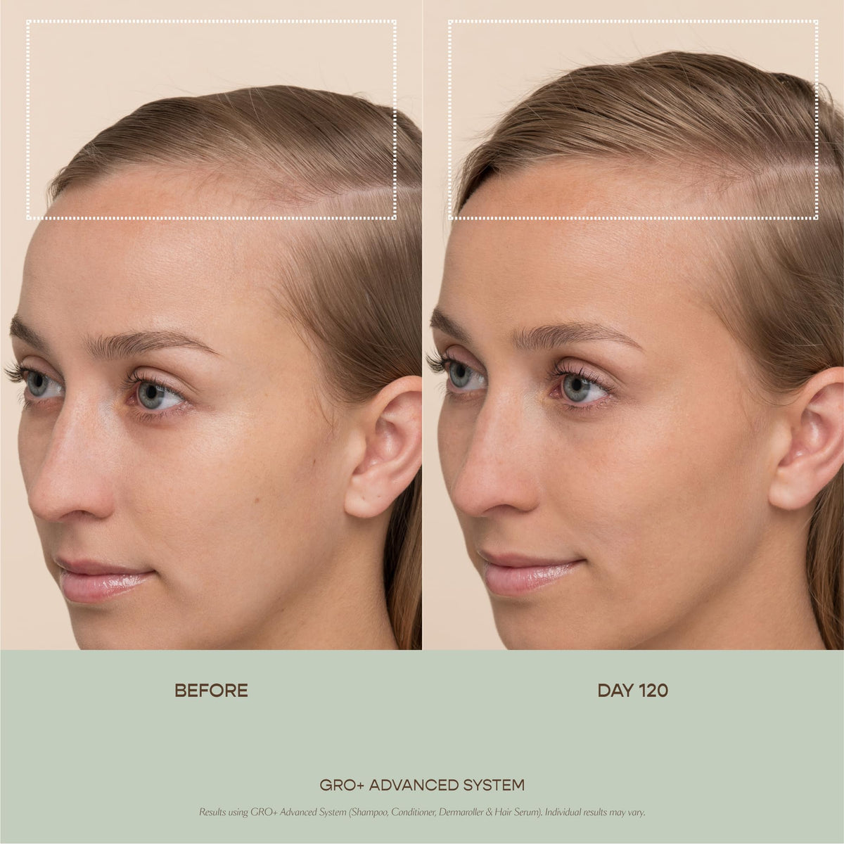 VEGAMOUR GRO+ Advanced Dermaroller | 1,200 Microneedle 0.25mm Scalp Tool | Gently Exfoliates the Scalp | Wide Head for Maximum Coverage - Maple Wellness Supplements